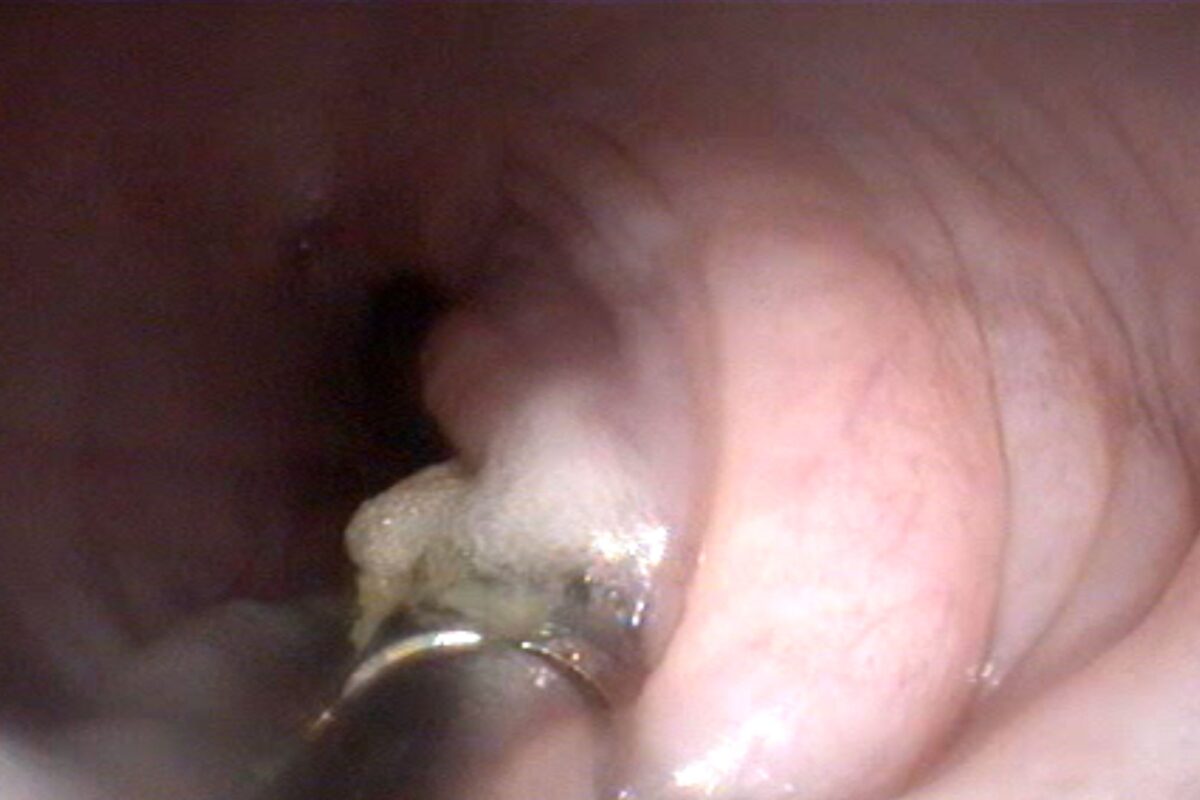 ENDOSCOPIA