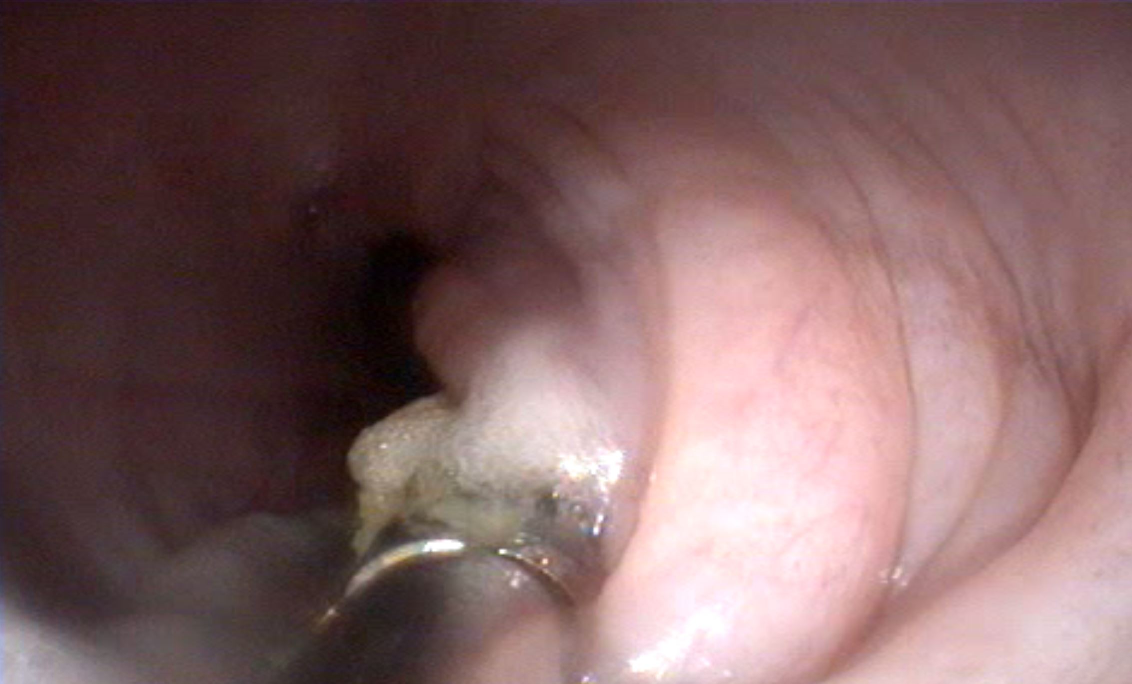 endoscopia